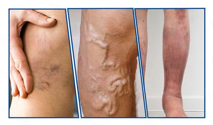 🇭🇺𝐇𝐞𝐚𝐥𝐫𝐢𝐳𝐞® 👩‍⚕️VeinTarget mikrotűs tapasz⚡☑️Azonnali enyhülés hosszú távú eredmények
