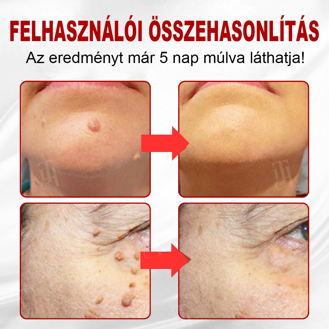 CleraNature® WartAway Pro tapaszo