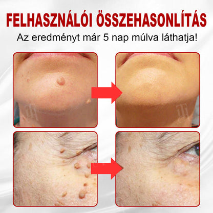 CleraNature® WartAway Pro tapaszo