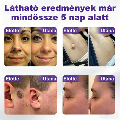 🛡️CleraNaure® mikrotűs szemölcs- és anyajegyeltávolító tapasz