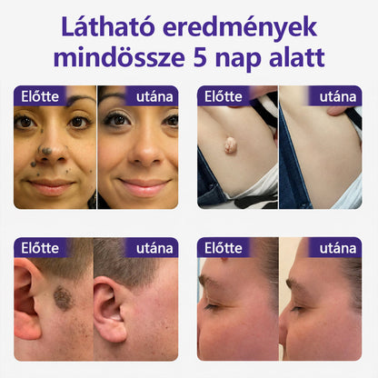 👩🏻‍⚕️COLTURE® szemölcs- és anyajegytávolító mikrotűs tapasz-🔥