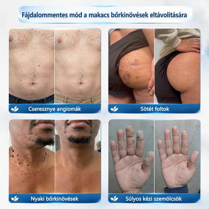 Hivatalos áruház🎉CleraNaure® 7 napos pigmentfolt- és bőrhiba-eltüntető kezelés (Fájdalommentes, hegmentes görgős applikátor)