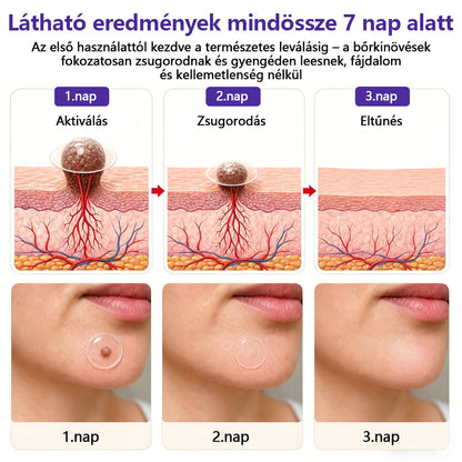 👩🏻‍⚕️COLTURE® szemölcs- és anyajegytávolító mikrotűs tapasz-🔥