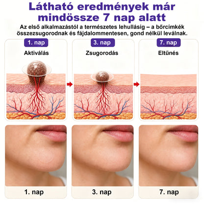 🛡️CleraNaure® mikrotűs szemölcs- és anyajegyeltávolító tapasz